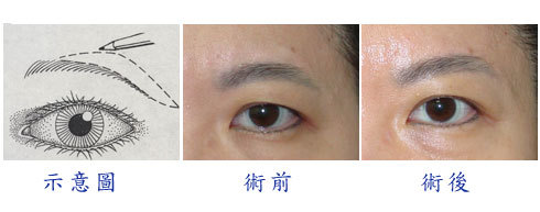 上图例有明显眉毛下垂及眼尾下垂,右图是做完上眉切及将部份眼尾